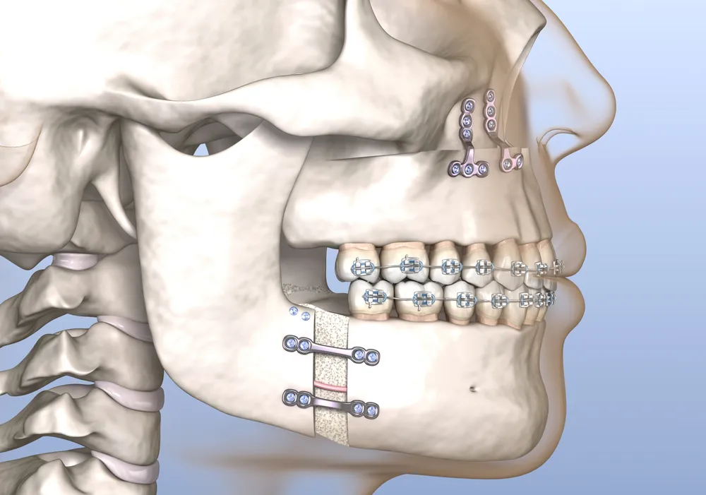 Orthognathic Surgery